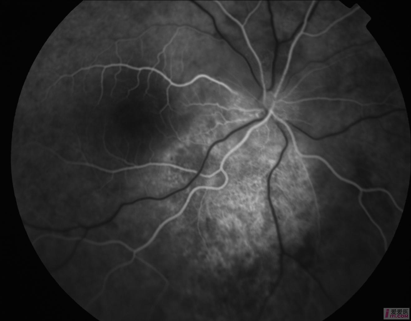 【资源】脉络膜骨瘤