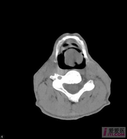 喉返神经CT图片