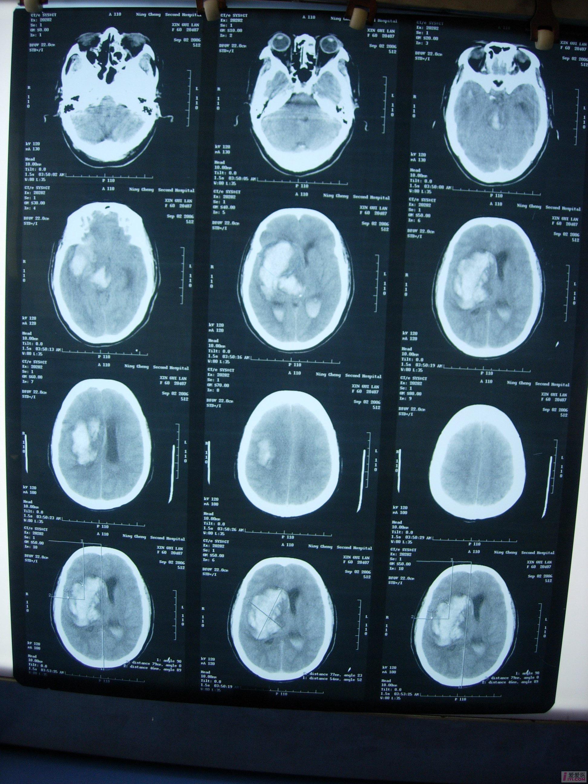 【討論】大量腦出血 歡迎大家來討論