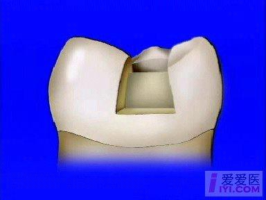 口腔二类洞各个壁图片图片