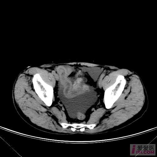原创精彩急诊ct图片膀胱破裂