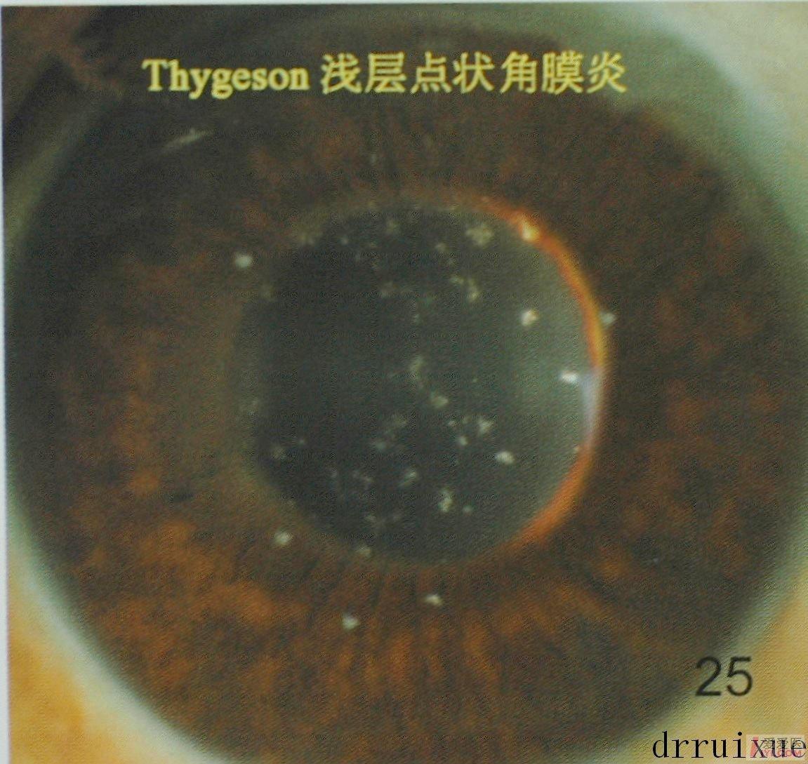 thygeson浅层点状角膜炎.jpg