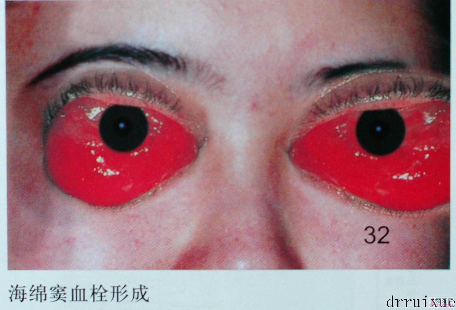 【资源】【眼表病彩色图片】20幅