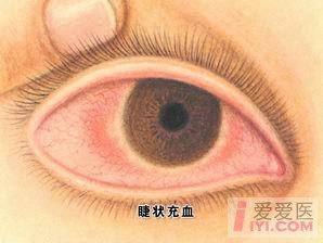 【即时求助】什么是睫状充血?混合充血?