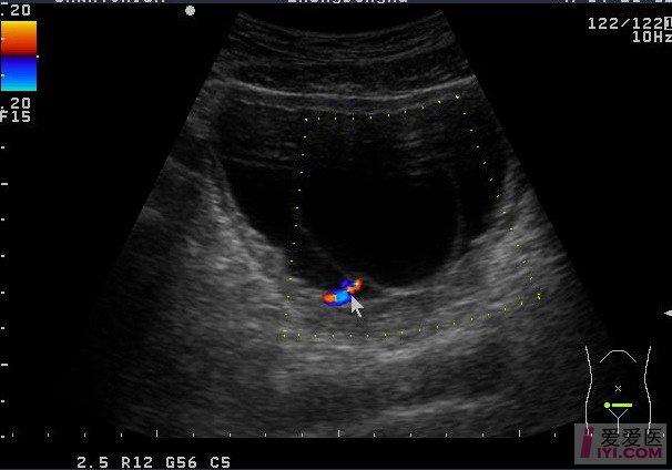 【分享】超经典输尿管囊肿一例 超声医学讨论版 爱爱医医学论坛