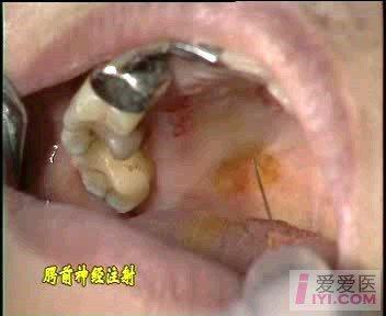 贴图资源腭大孔麻醉图解