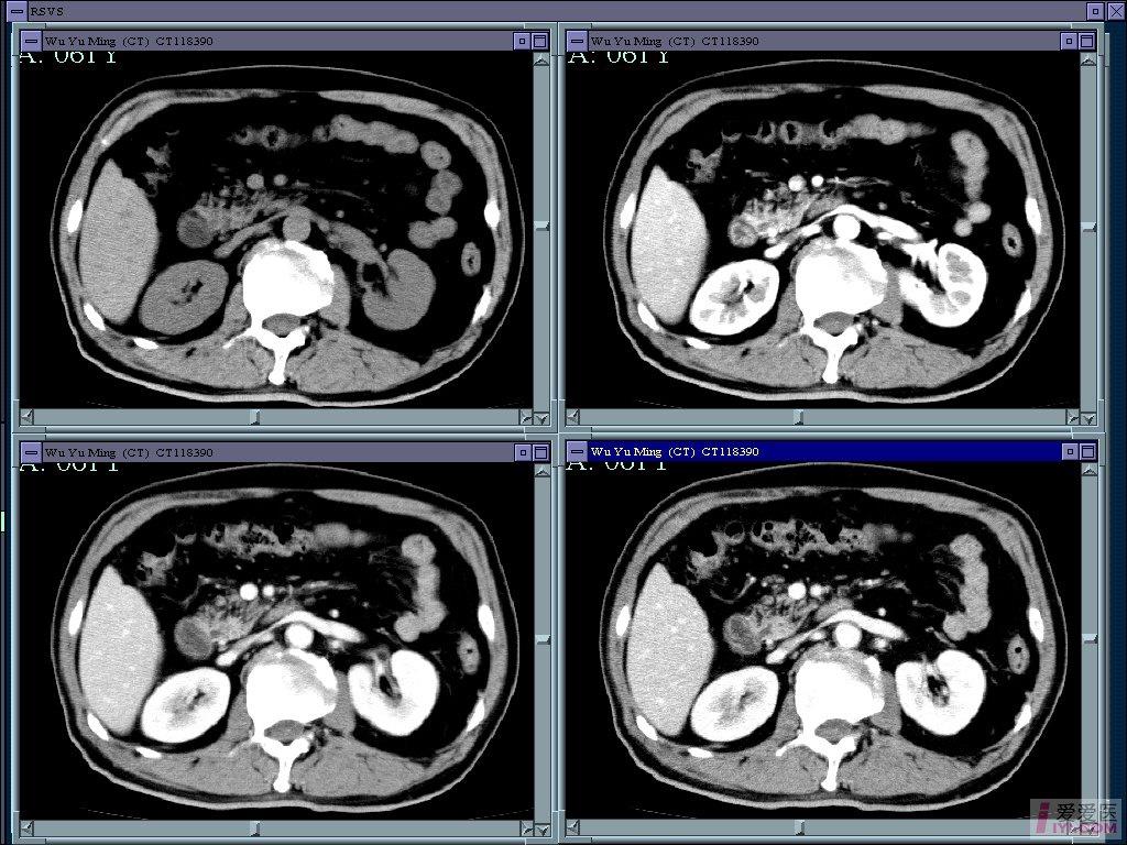 【原创】十二指肠间质瘤的ct四期通览图