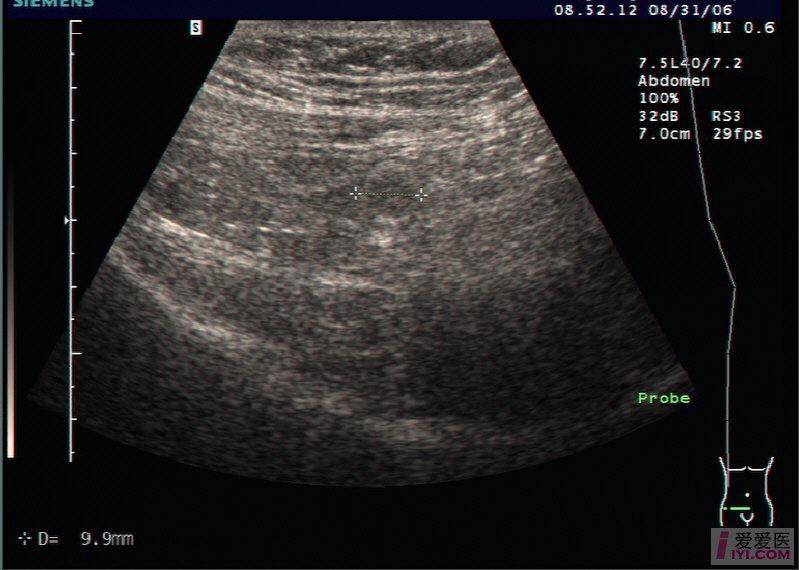 粪石超声图图片