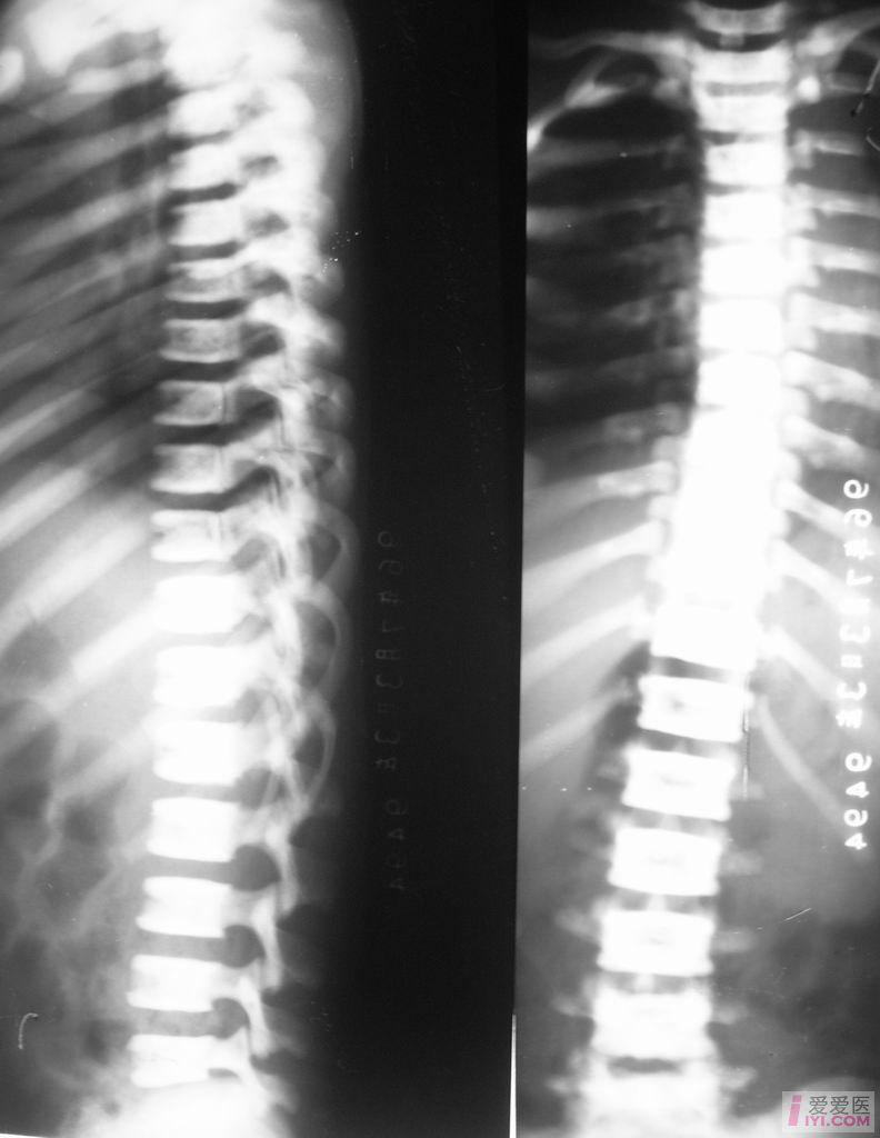 【原创】石骨症 - 医学影像学讨论版 - 爱爱医医学论坛