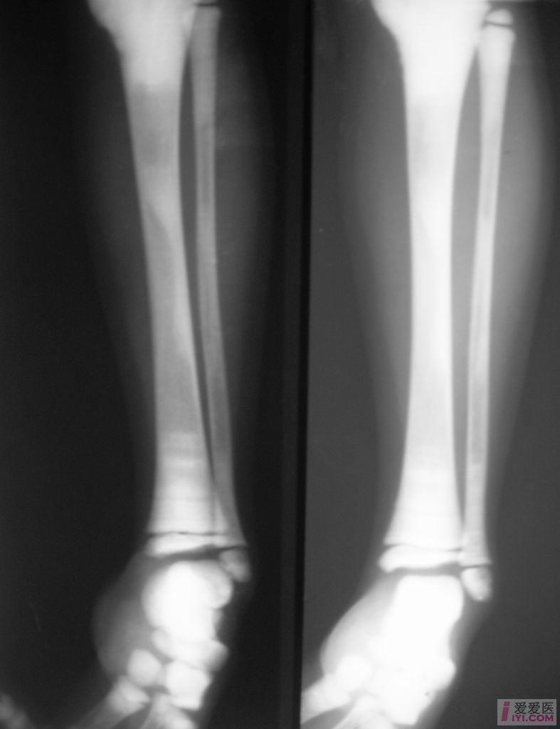 【原创】石骨症 - 医学影像学讨论版 - 爱爱医医学论坛