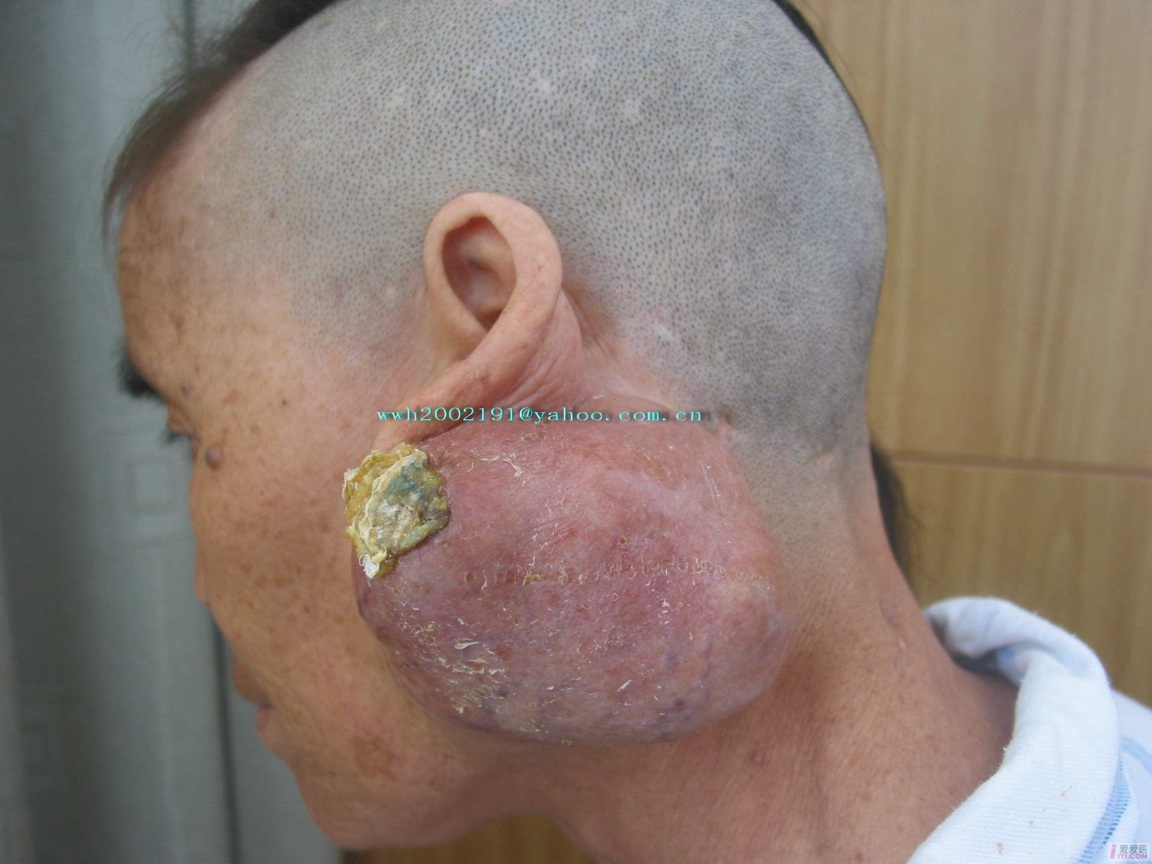 腮腺混合瘤图片恶性图片