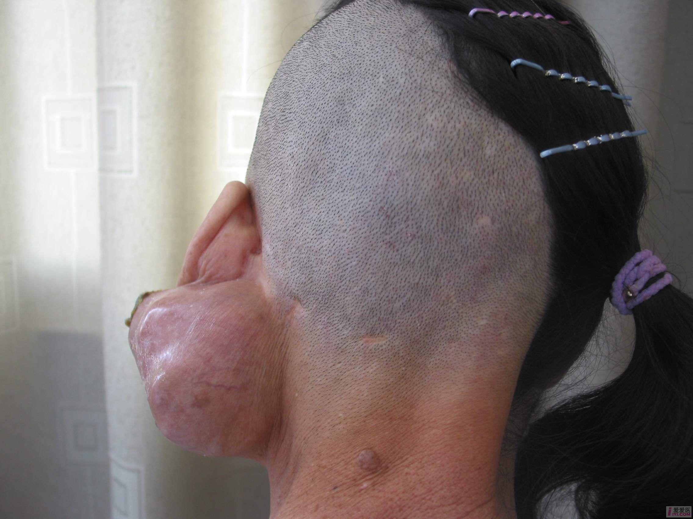 腮腺混合瘤症状图片