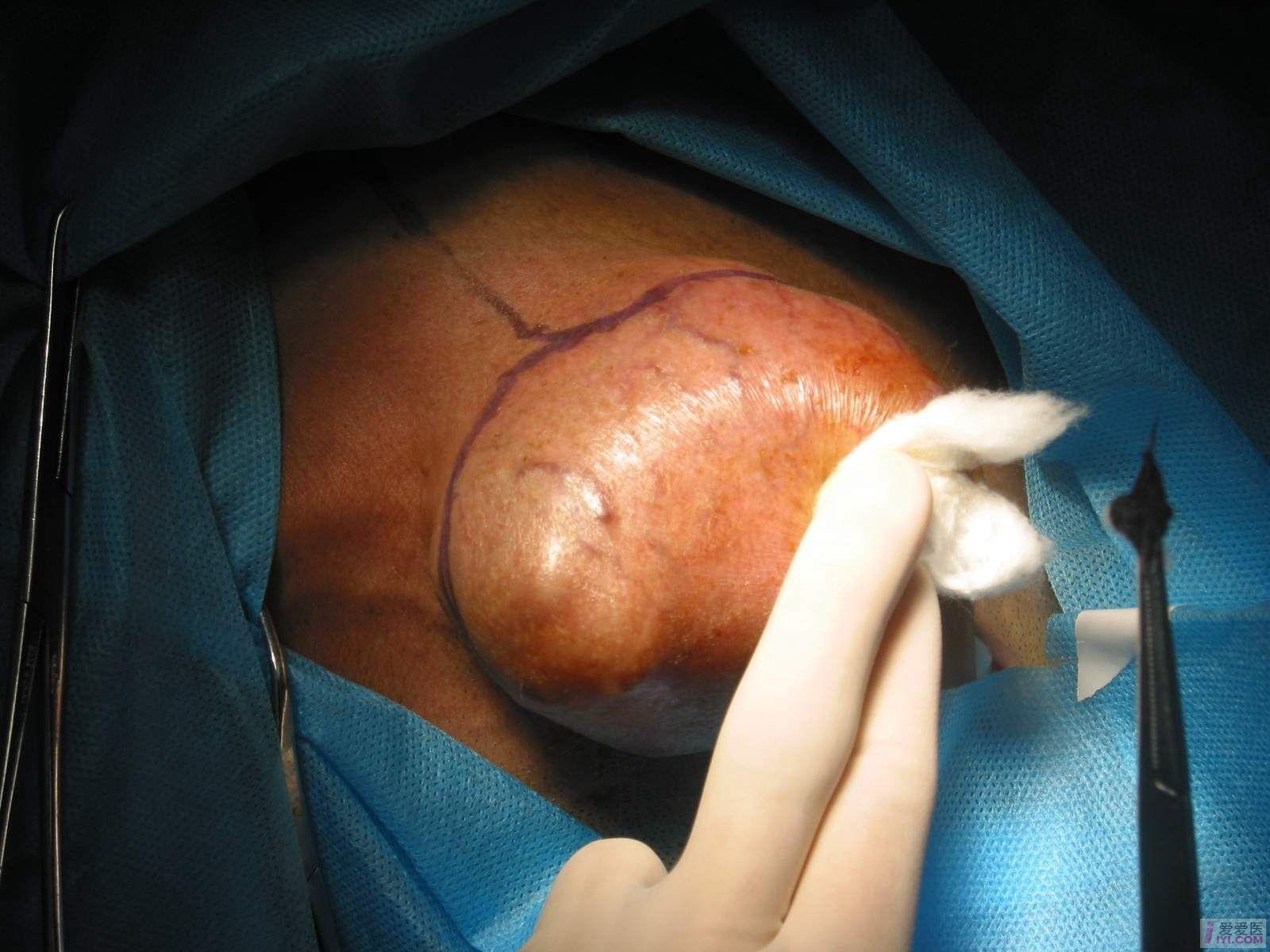 腮腺混合瘤图片 恶性图片