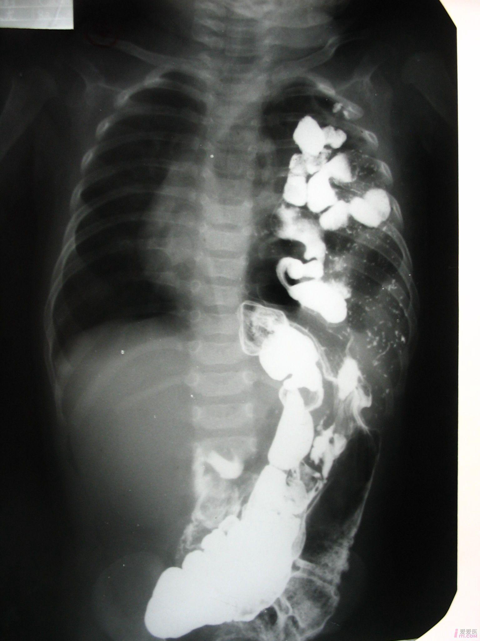 膈疝x线图片图片