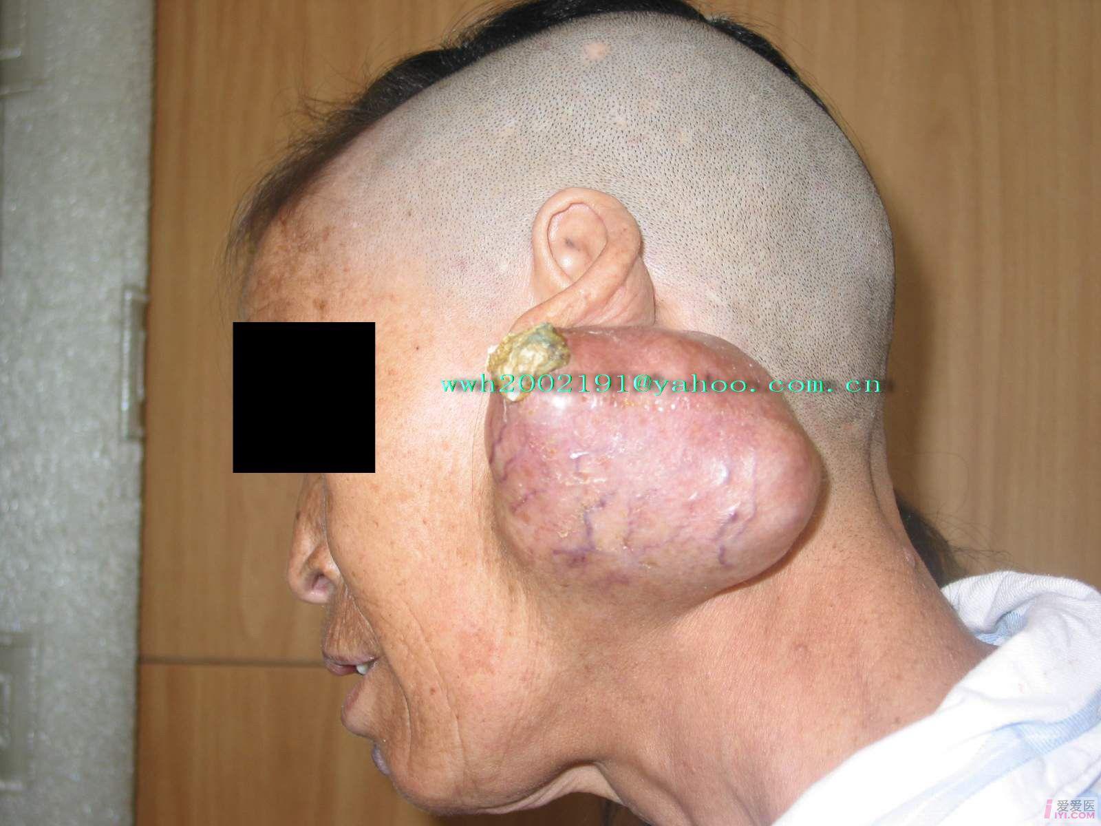 腮腺混合瘤图片恶性图片