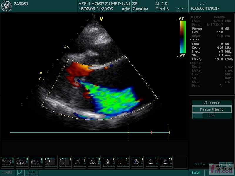 二尖瓣关闭不全超声图片