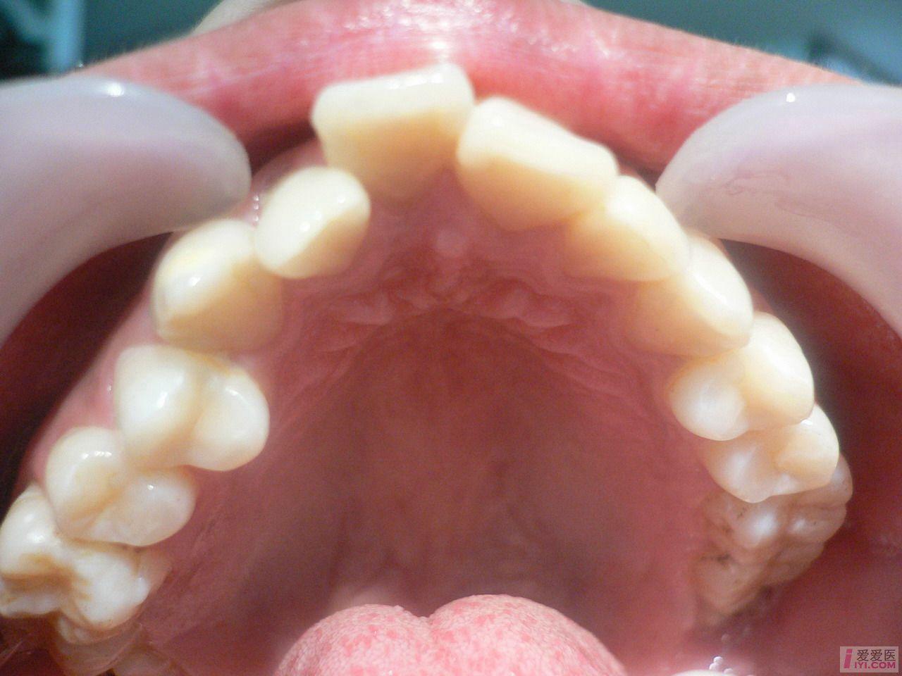 牙齿畸形种类图片图片