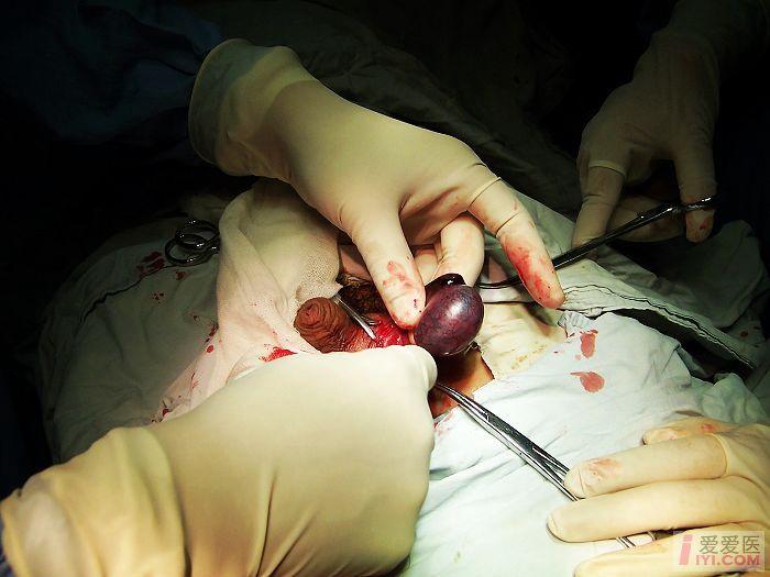 睾丸扭转手术图片图片