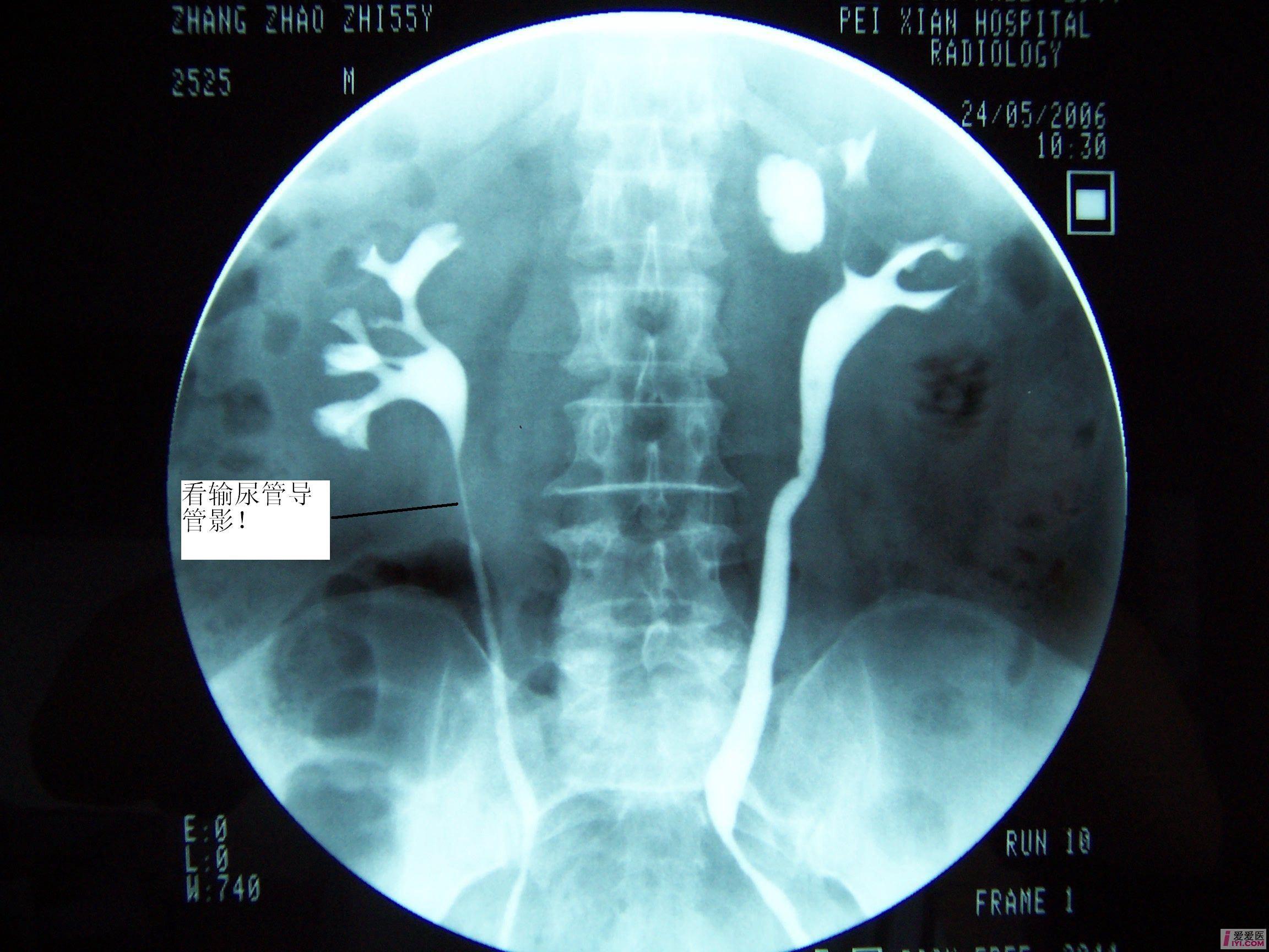 原创女性50岁左腰部酸胀不适病史1年已公布结果