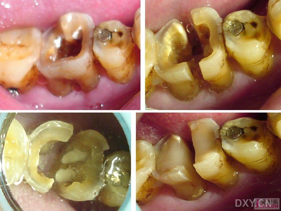 磨牙髓室底穿通的保存治疗