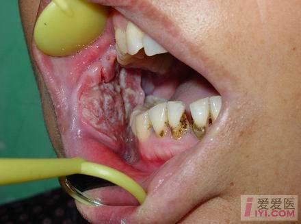 口咽癌图片 初期图片