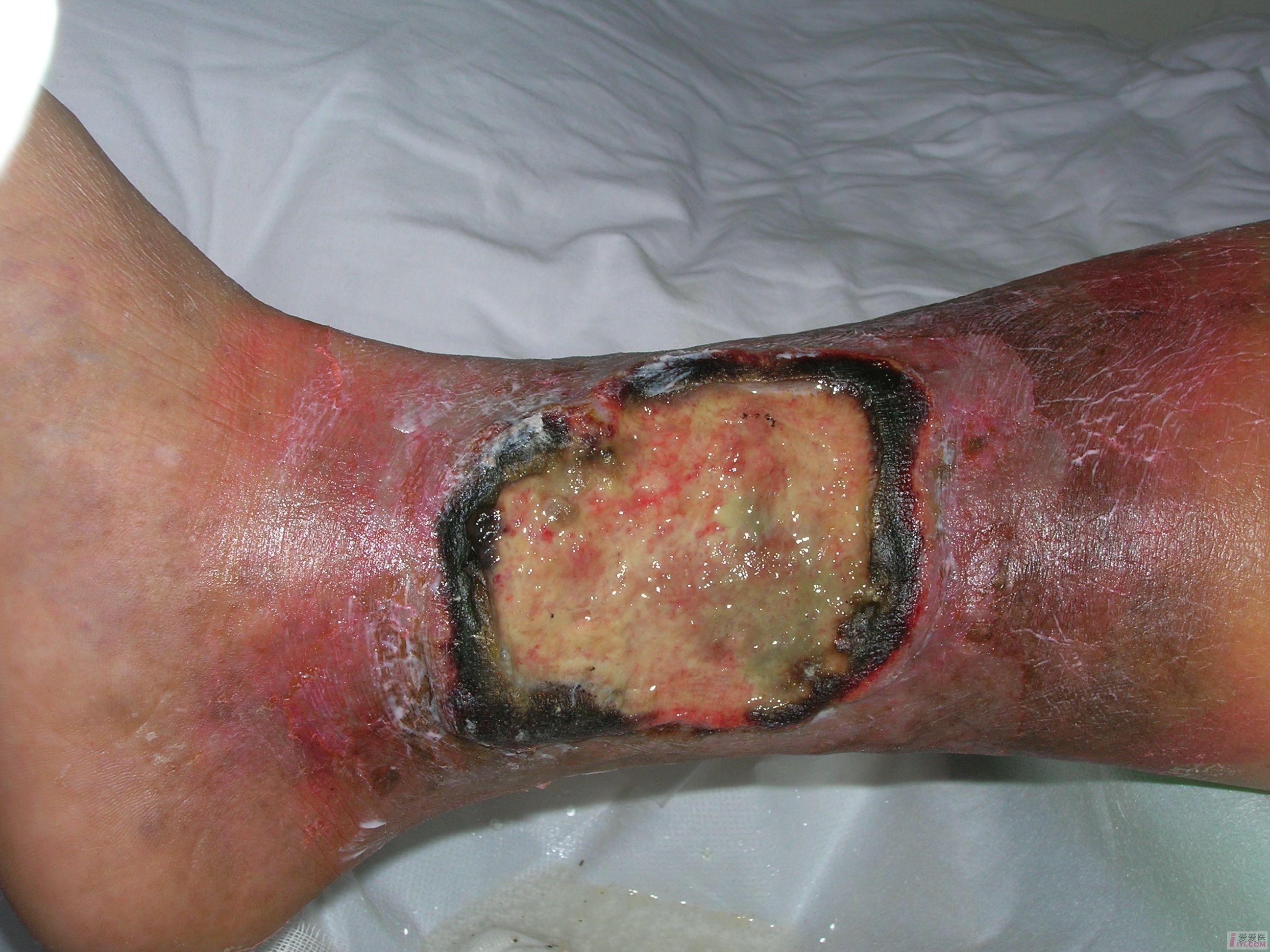 【转贴】一例下肢溃疡
