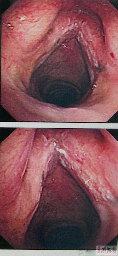 声门型喉癌t1b.jpg