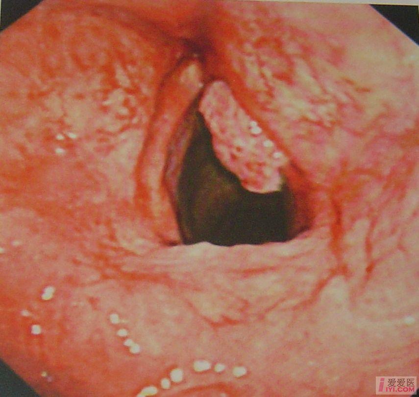 声门型喉癌t2.jpg