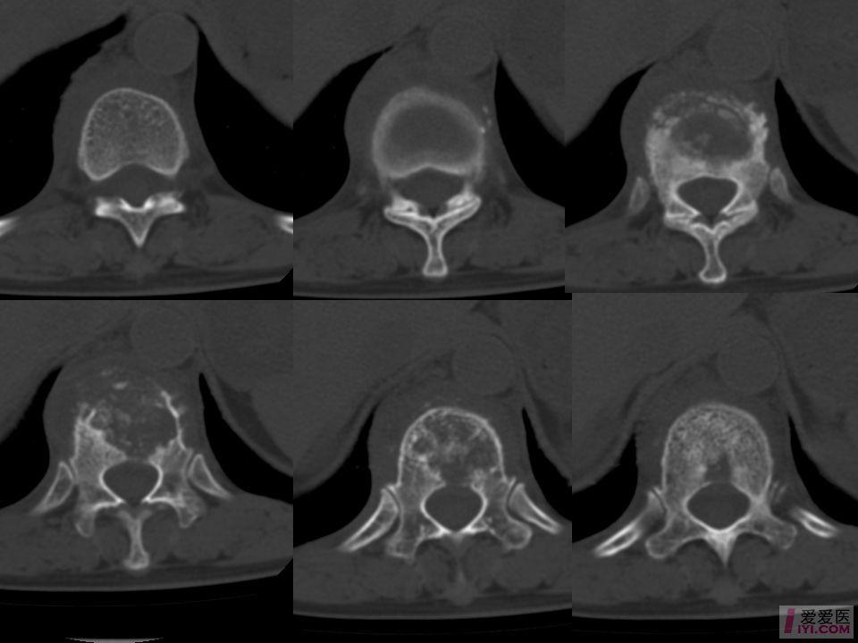 腰椎骨质增生ct图片