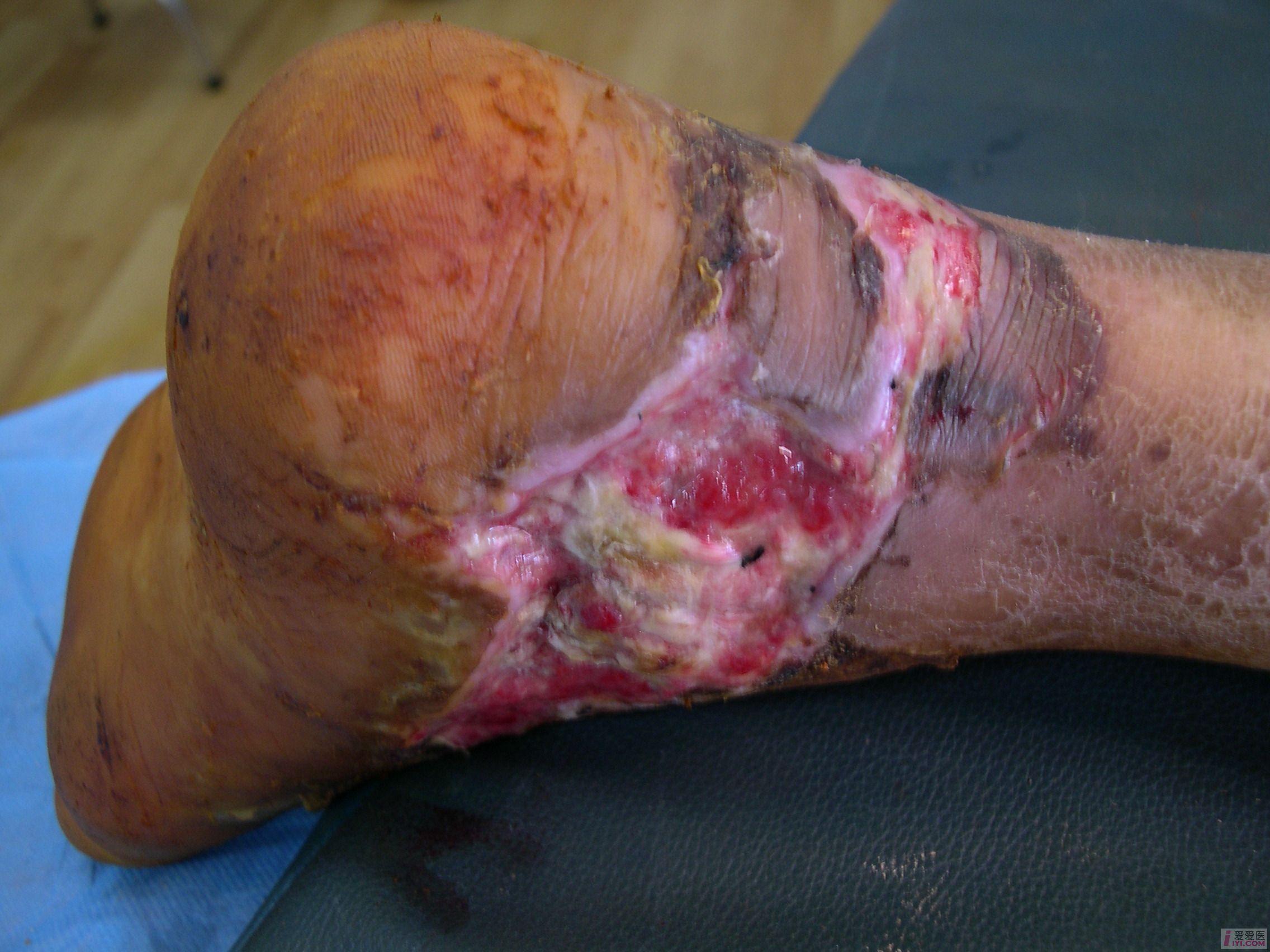 内踝骨外露伴感染