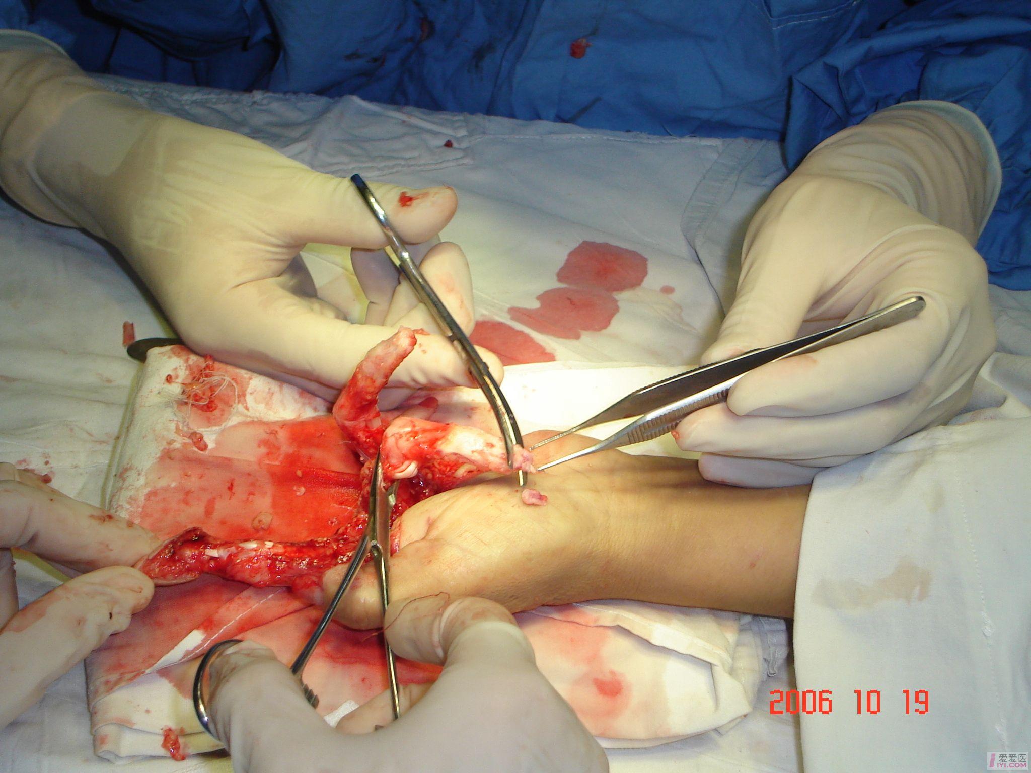 大家讨论下这怎么处理好[手外伤] - 骨科与显微外科专业讨论版 - 爱爱