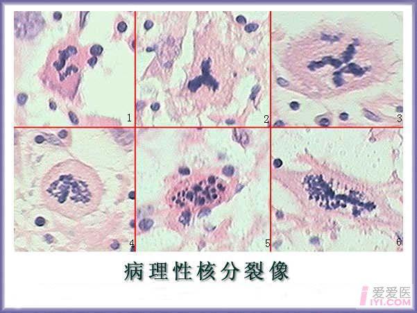 病理性核分裂像