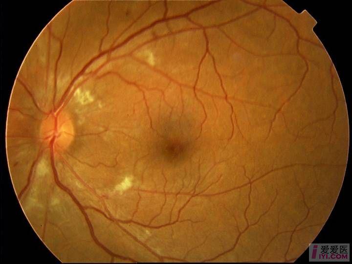 高血压性视网膜病变3期