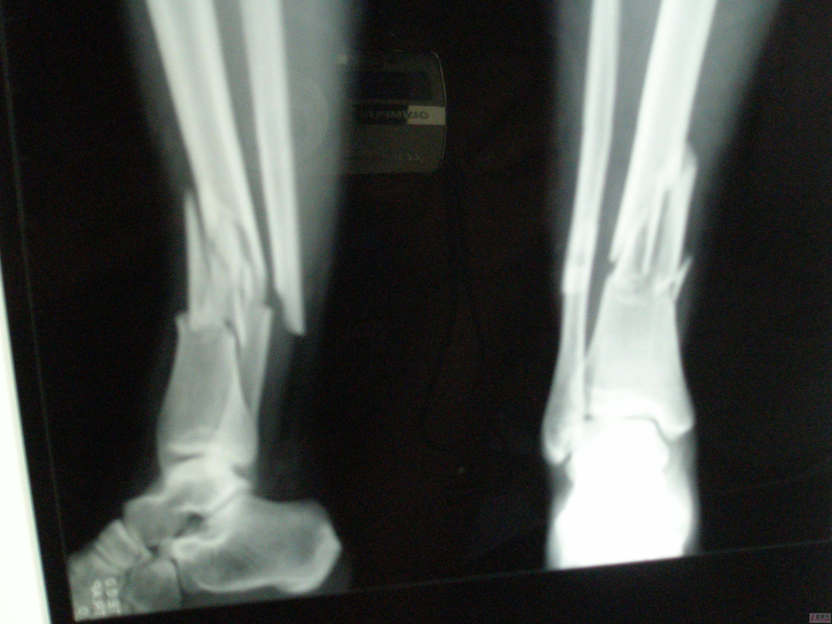 男生腿骨折图片