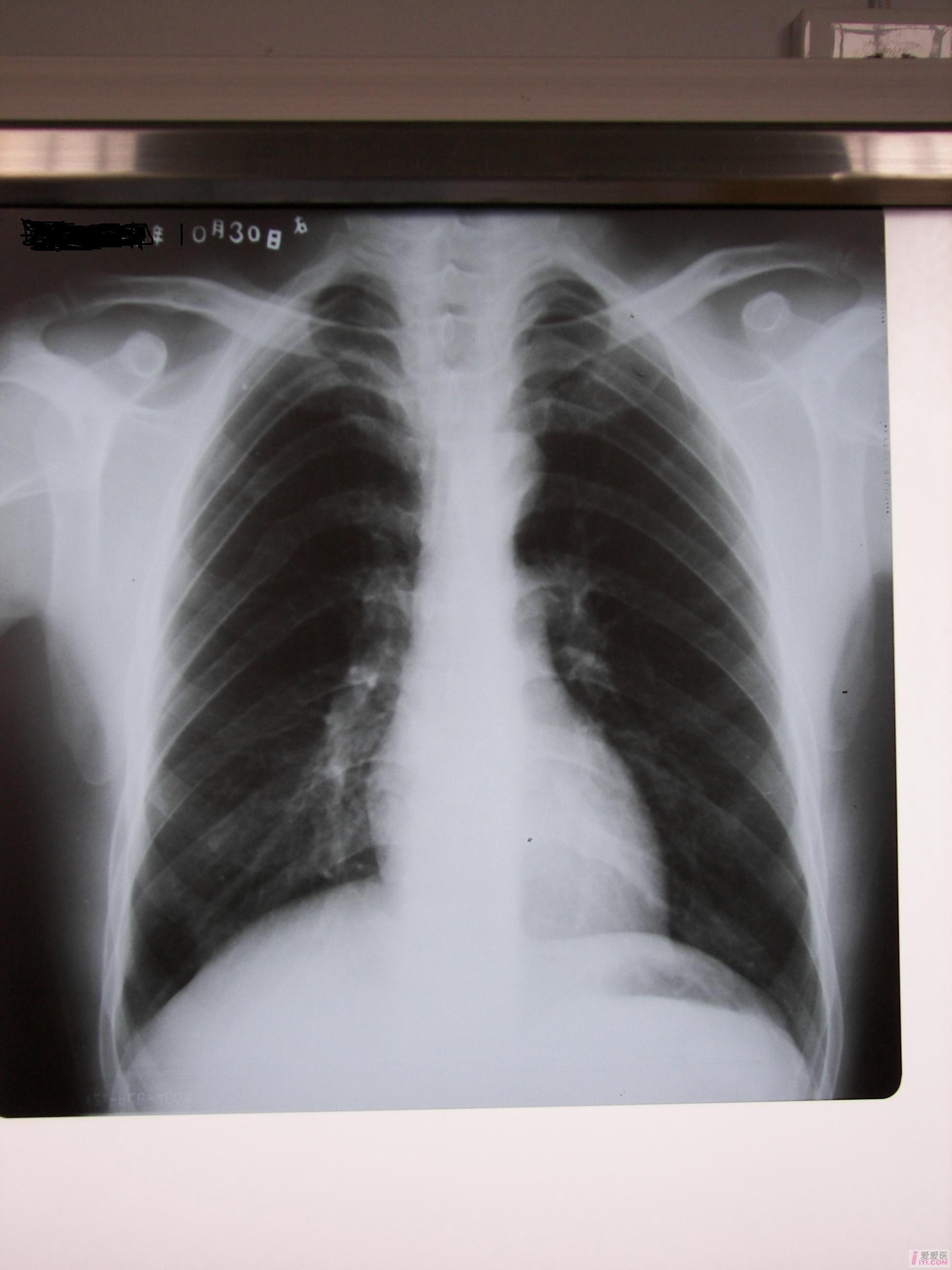 肺炎ct图片 片子图片