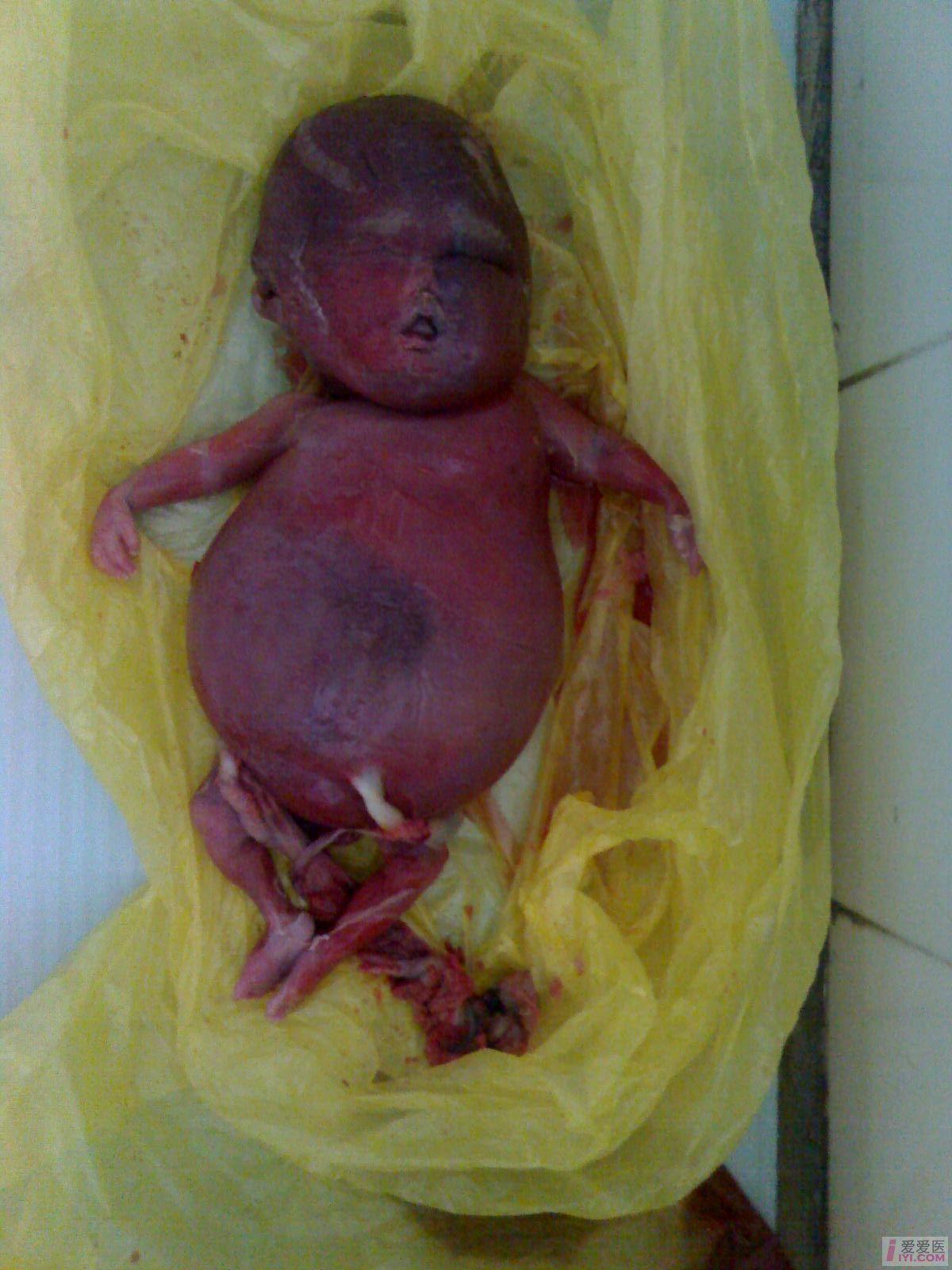 barts胎儿水肿综合征图片