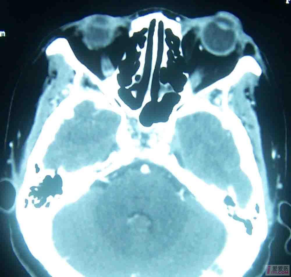 增强ct8.jpg