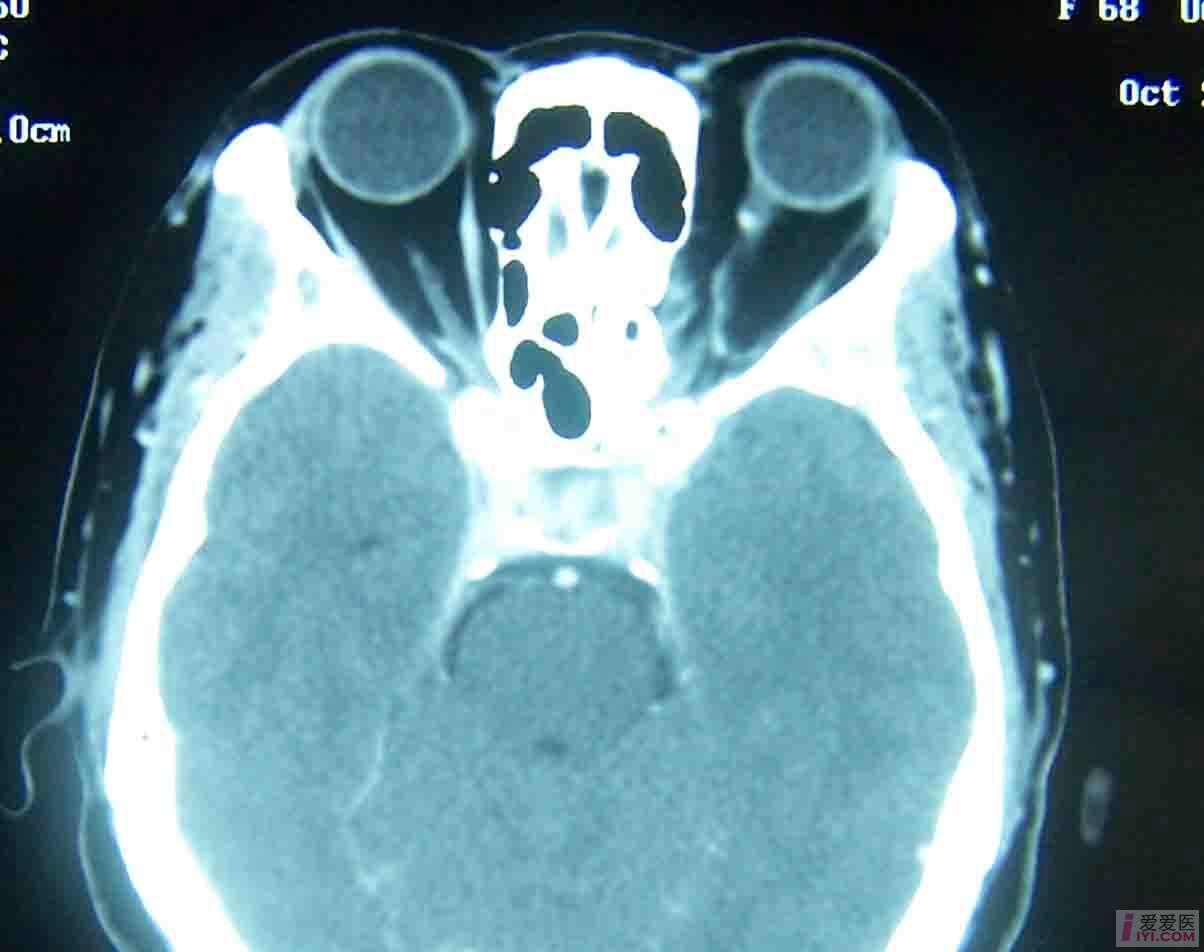 ct增强静脉期4.jpg