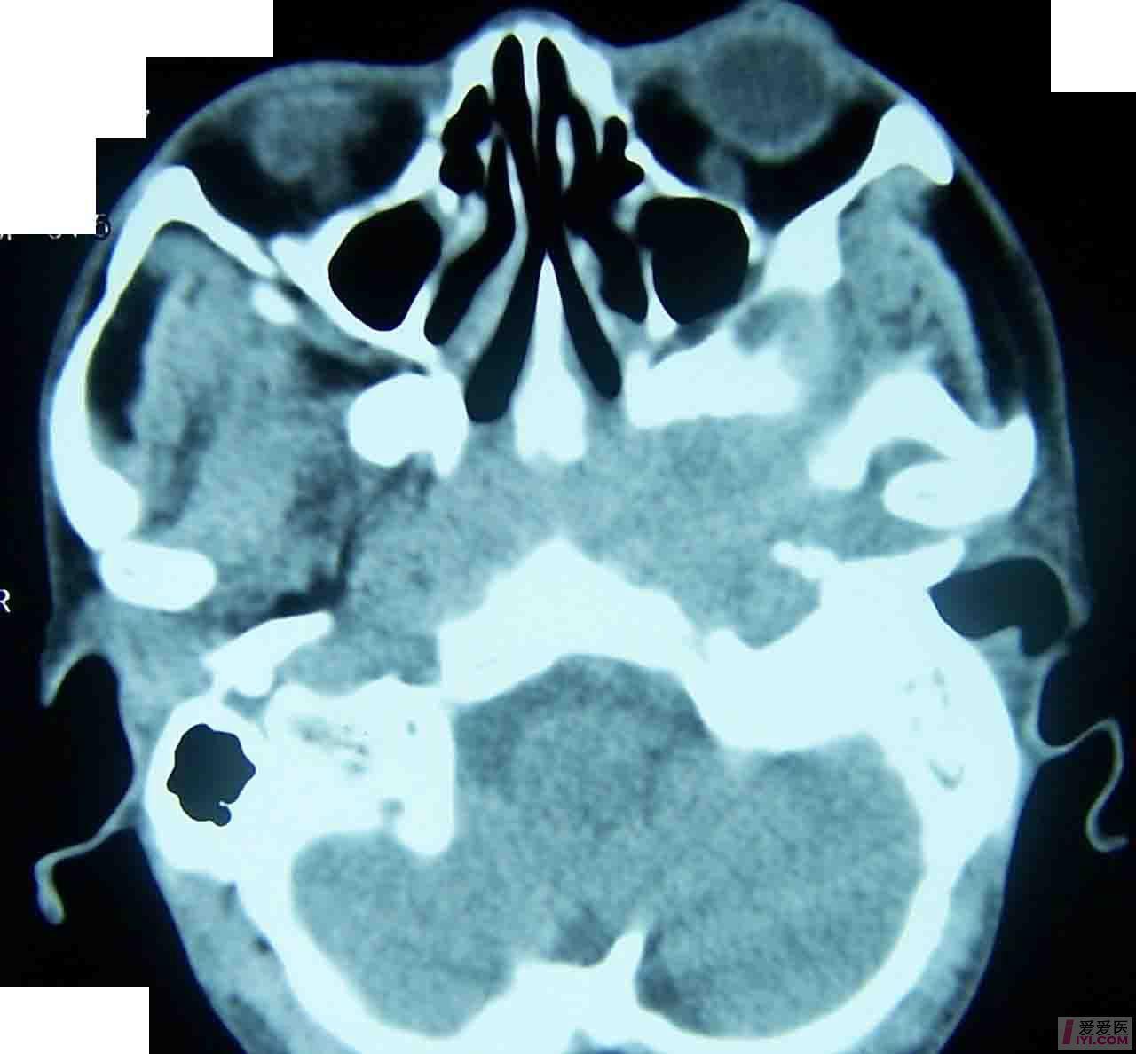 病例讨论以耳部侵犯为首发症状的鼻咽癌