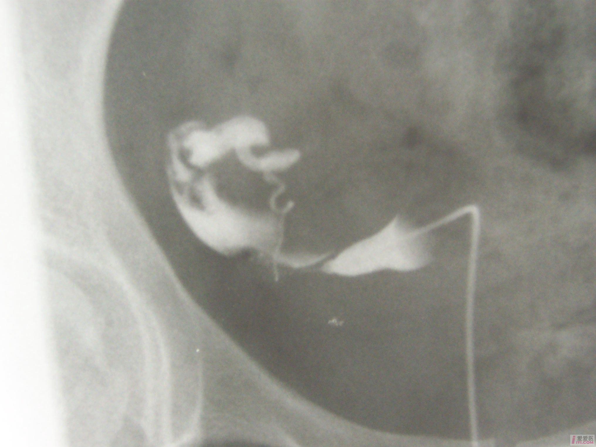 子宫输卵管造影128例临床分析很实用哟