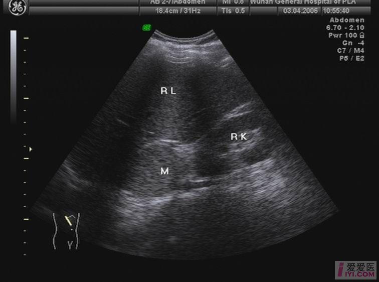 右肾上腺区占位
