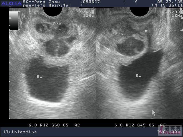 前庭大腺囊肿超声图片图片