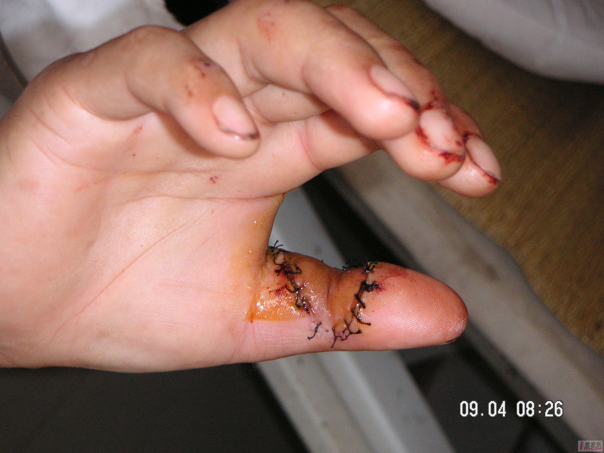 原创食指近节背侧岛状皮瓣