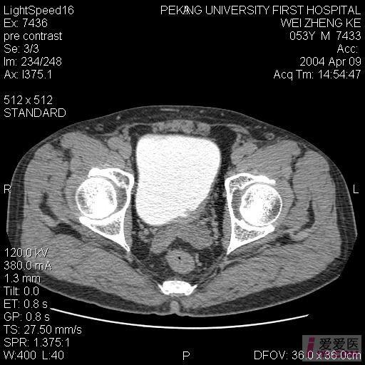 膀胱癌ct图片图片
