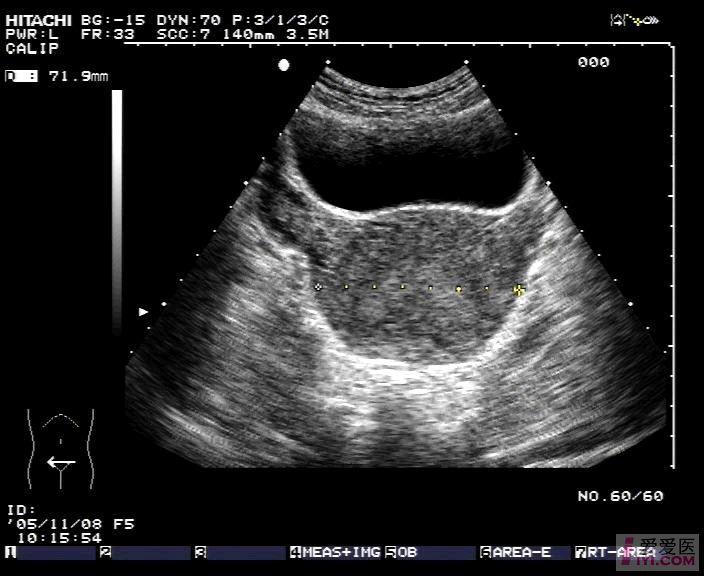 原创子宫先天发育畸形鞍状子宫