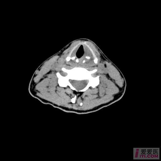 【原创】喉部ct