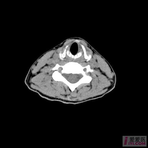 【原创】喉部ct