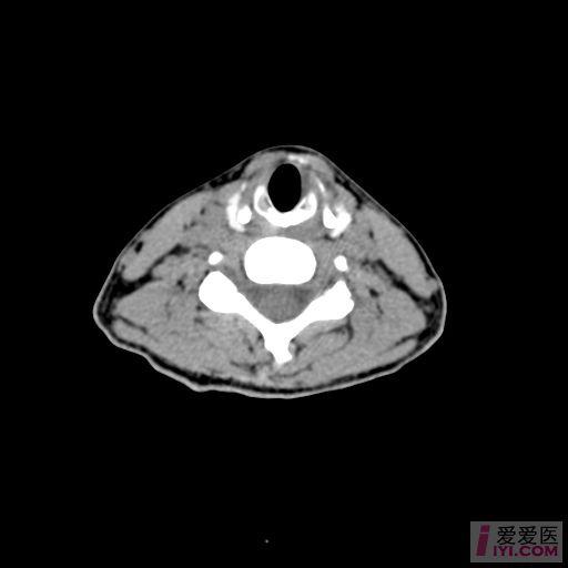 喉咽部ct图片