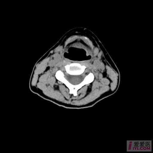 咽喉部ct扫描范围图片图片