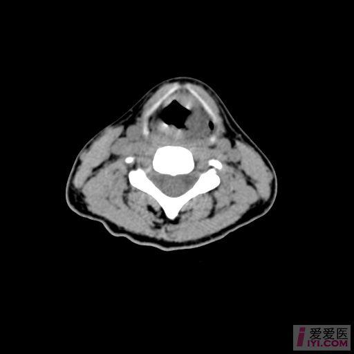 原創喉部ct